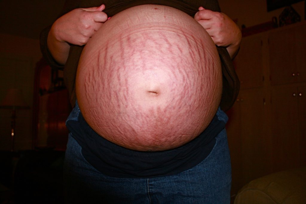 les-vergetures-pendant-la-grossesse